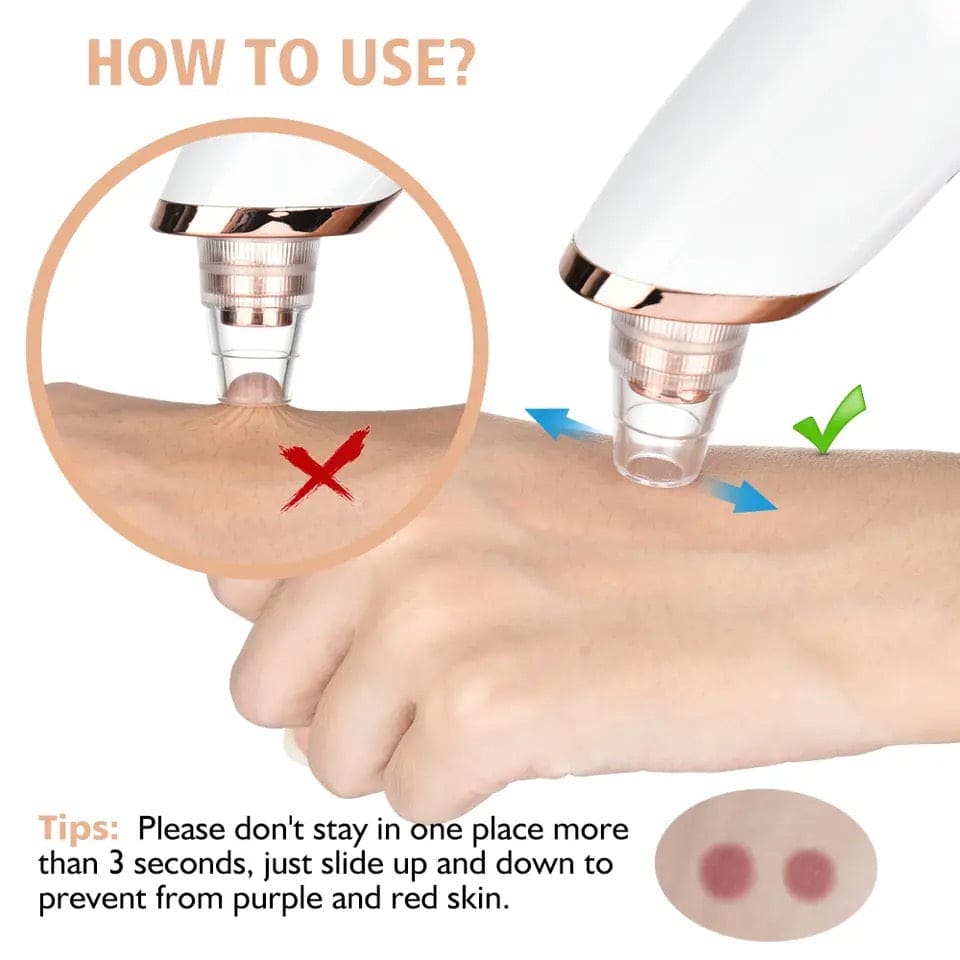 Blackhead Remover – 5-in-1 Blackhead Suction Vacuum | Electric Pore Cleaner, Acne Extractor & Facial Skin Cleaner